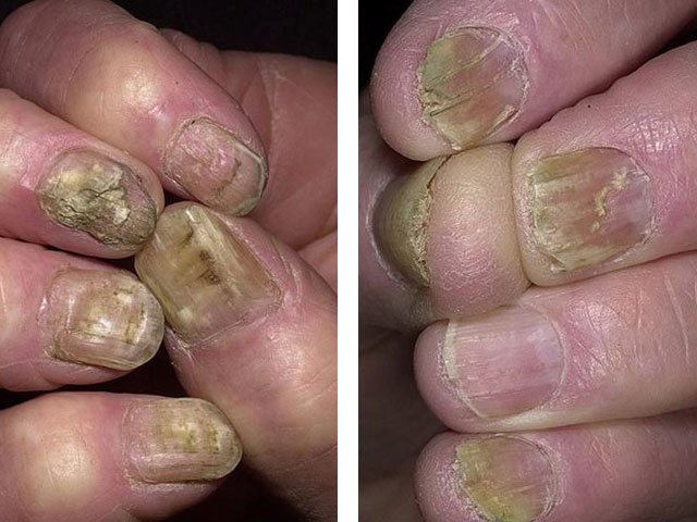 Traitement fongique des ongles sur les mains à la maison.