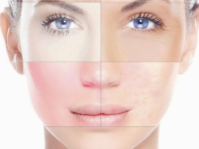 Types de peau Types de peau