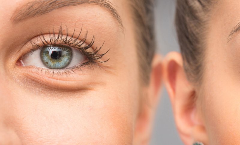 Sacs sous les yeux Sacs sous les yeux