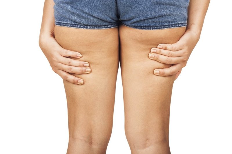 Petite cellulite sur les jambes Causes de l'apparition de la cellulite
