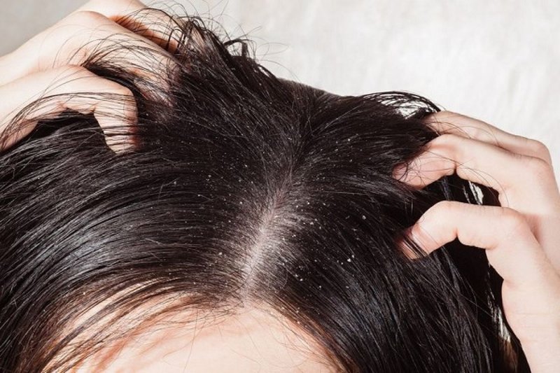 Antipelliculaire Antipelliculaire