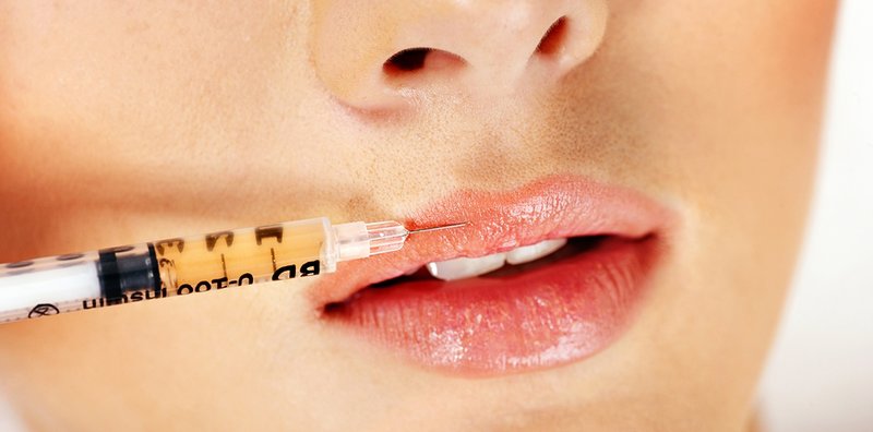 Lipolifting Lipolifting