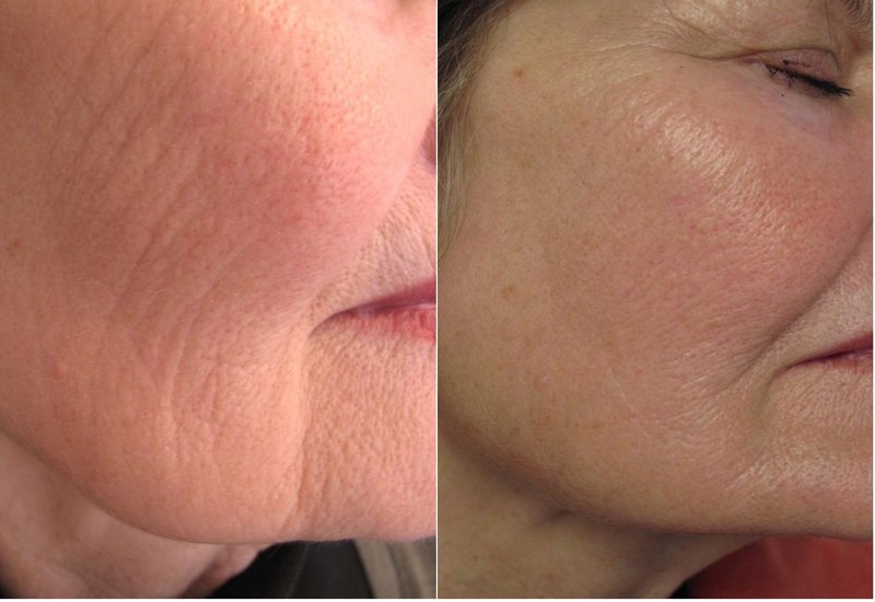 Ptosis Correction 5 traitements Ptosis Correction 5 traitements