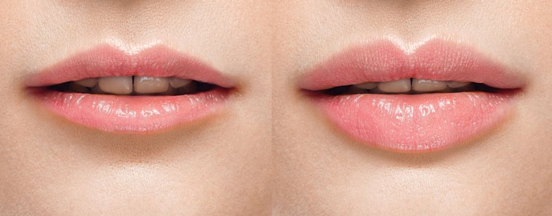 Augmentation des lèvres avec acide hyaluronique Augmentation des lèvres avec acide hyaluronique