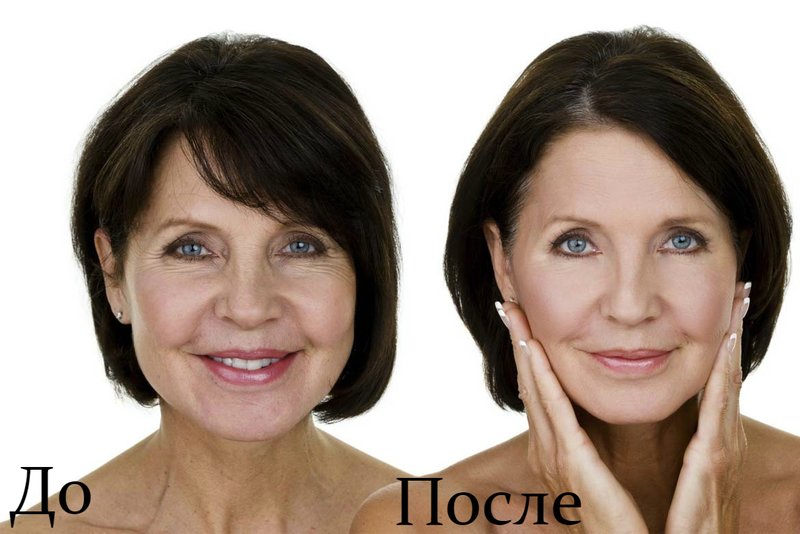 Le résultat avant et après la procédure de levage ultraformer Avis patients avec photos