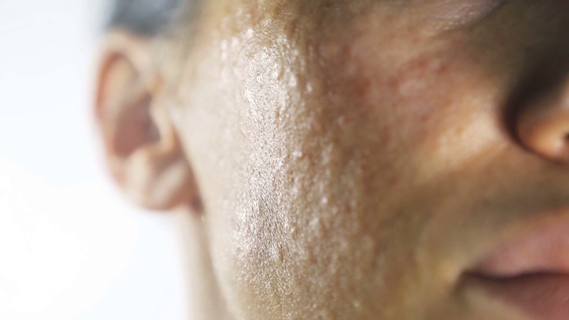 Papules d'un diamètre de 1 mm sur la face Papules d'un diamètre de 1 mm sur la face