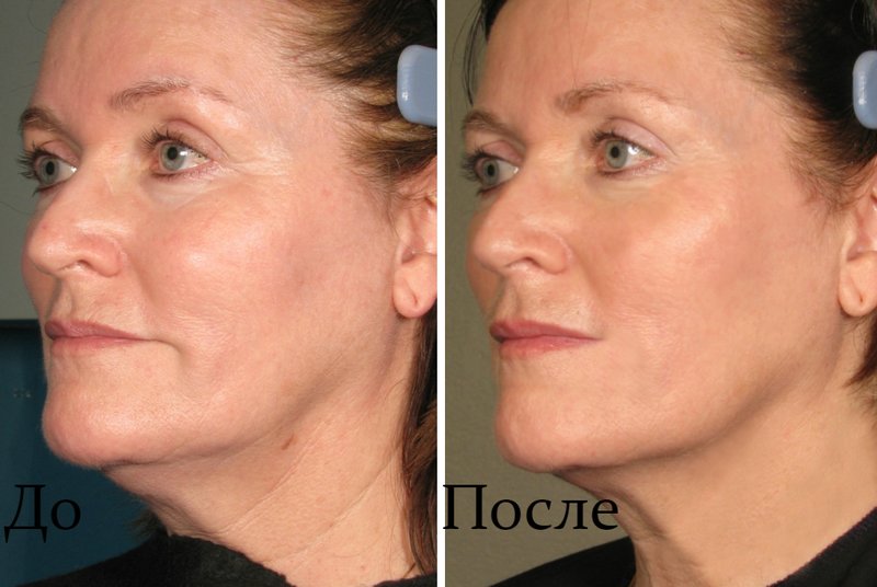 Le résultat avant et après la procédure de levage ultraformer Ultraformer lifting: avis de patients