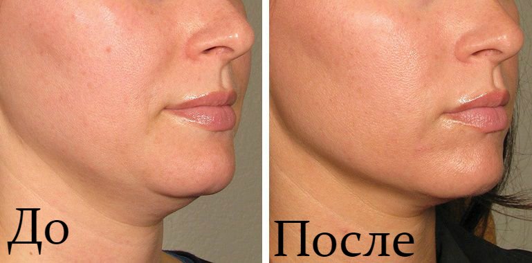 Le résultat avant et après la procédure de levage ultraformer Avis de patients après un ultra-lifting