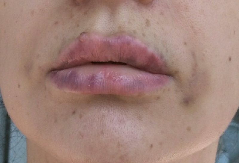Las consecuencias de un aumento de labio fallido Las consecuencias de un aumento de labio fallido