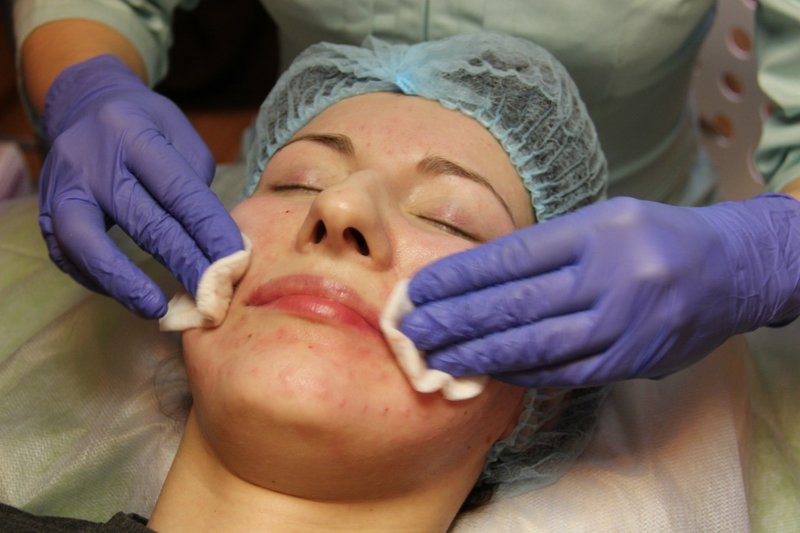 Traitement de la peau après la bio-revitalisation Traitement de la peau après la bio-revitalisation