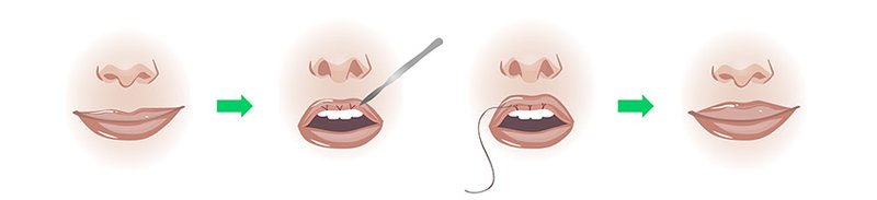 VY en plastique VY en plastique