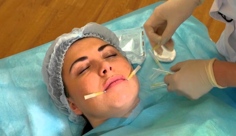 Lifting des lèvres Lifting des lèvres