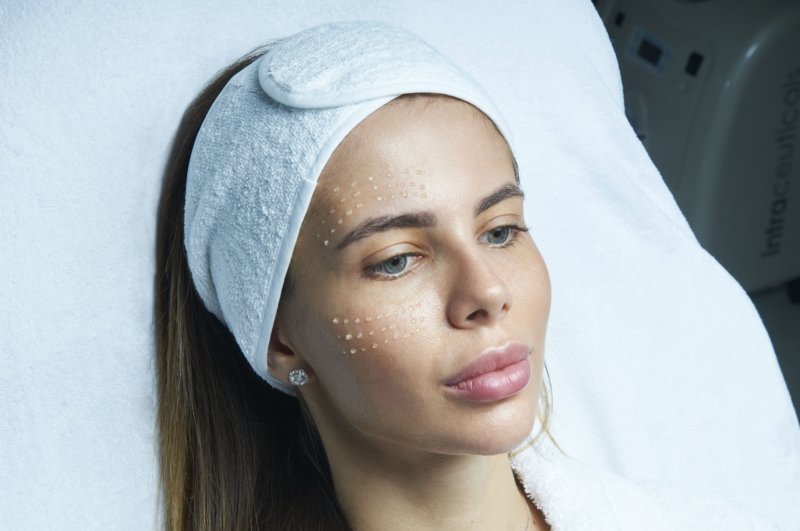 Fuite de préparation d'acide hyaluronique sur les sites de ponction Fuite de préparation d'acide hyaluronique sur les sites de ponction