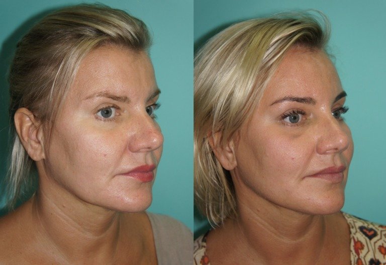 Levage circulaire avec des fils Kogi Levage circulaire avec des fils Kogi