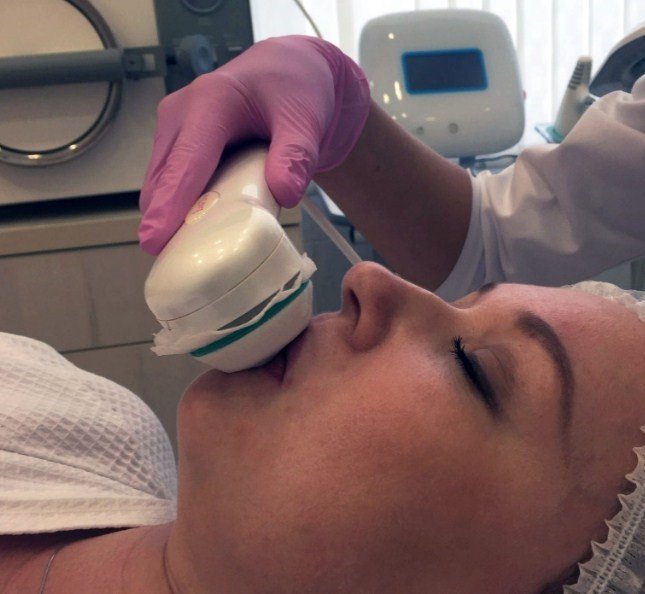 Électroporation des lèvres Électroporation des lèvres