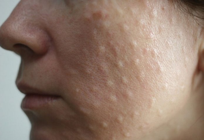 Papules après bio-revitalisation Papules après bio-revitalisation