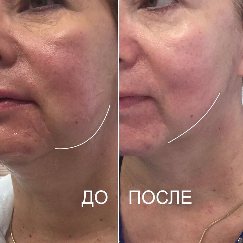 Résultats de levage SMAS avant et après Résultats de levage SMAS