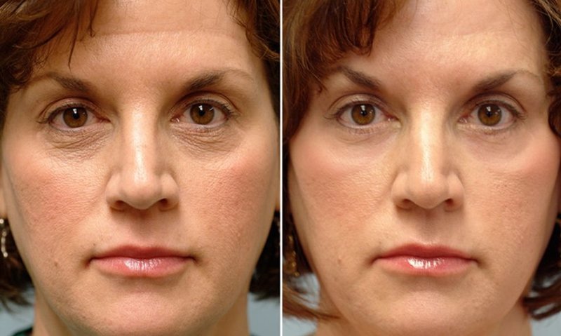 Correction du visage avec RF lifting 10 procédures Correction du visage avec RF lifting 10 procédures