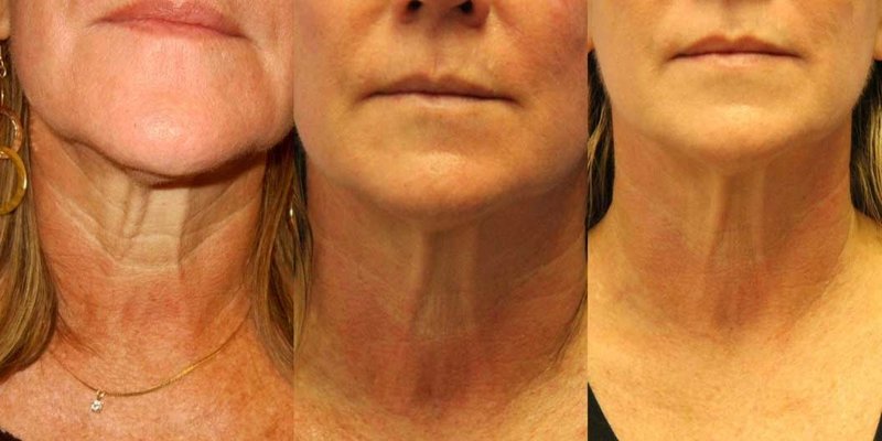 Correction du cou avec RF soulevant 4 procédures Correction du cou avec RF soulevant 4 procédures