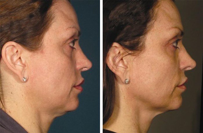 Le résultat de levage SMAS Le résultat de levage SMAS