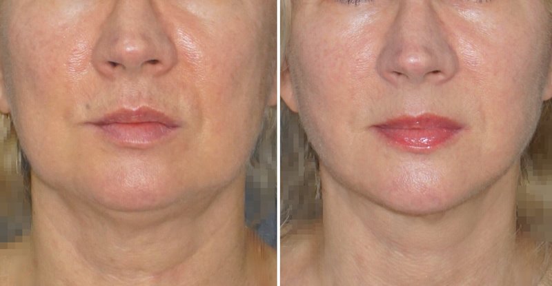 Résultat de levage SMAS Résultat de levage SMAS