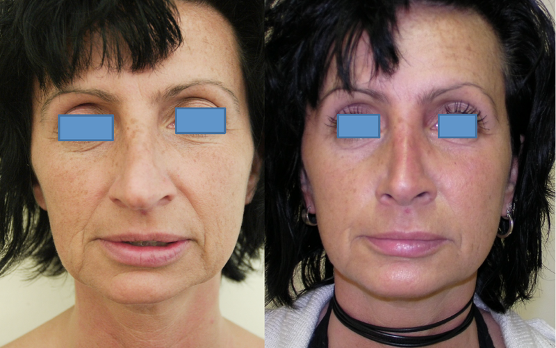 Smas levant avant et après les photos Smas levant avant et après les photos