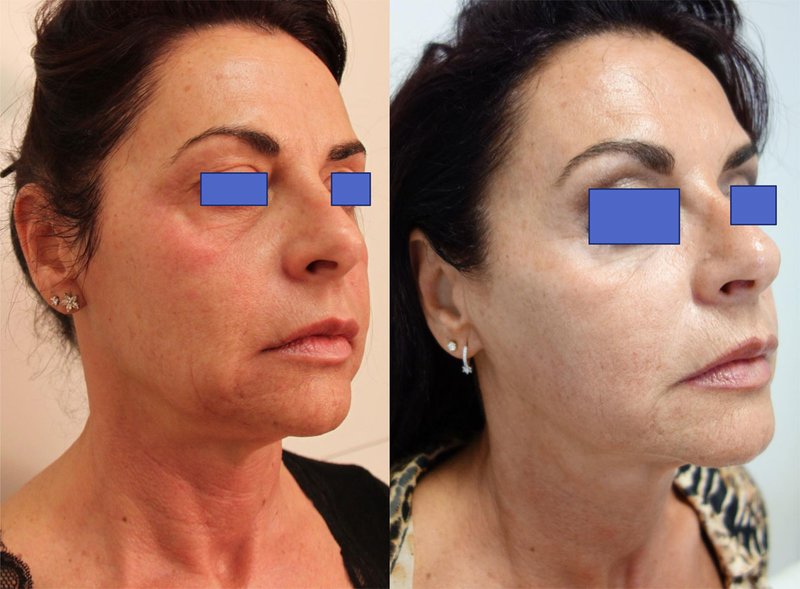 Résultat après smas-lifting Résultat après smas-lifting