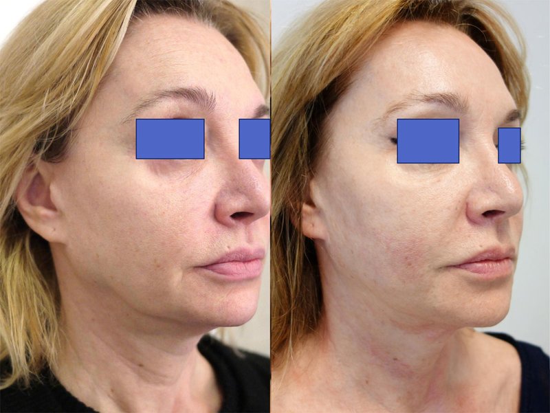 Photos avant et après smas-lifting Photos avant et après smas-lifting